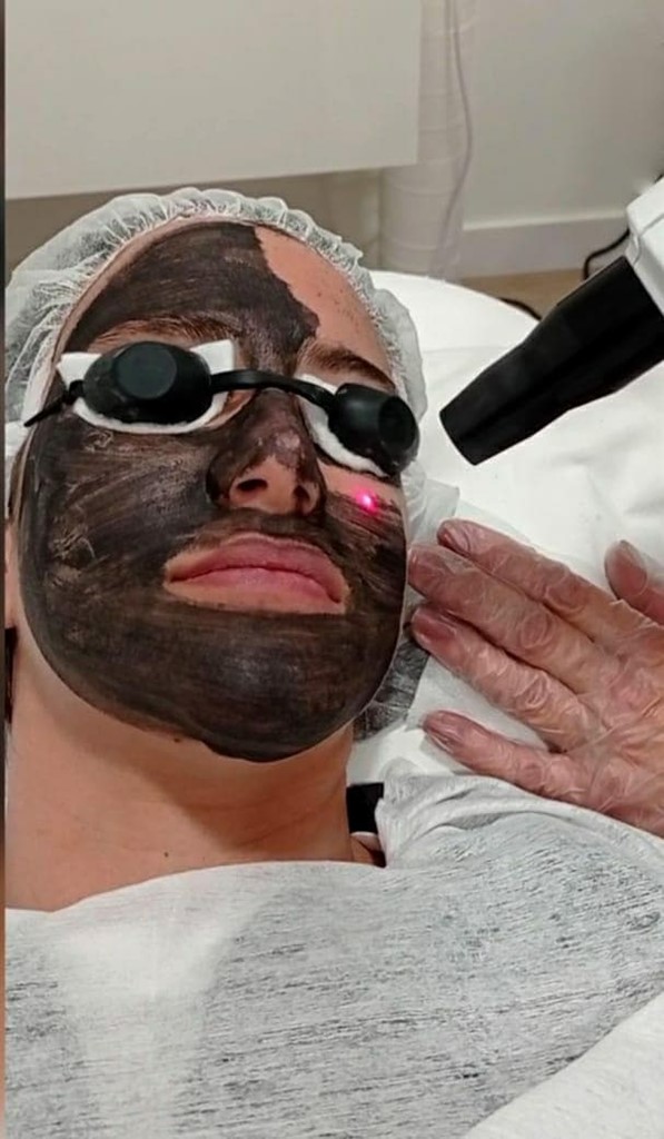 LÁSER CARBON PEEL