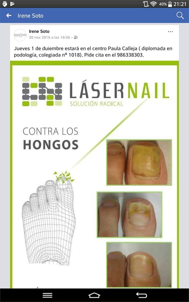 Laser nail 