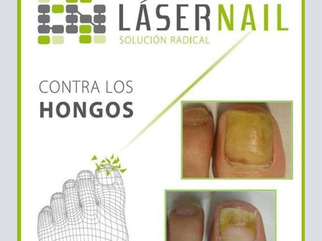 Laser nail 